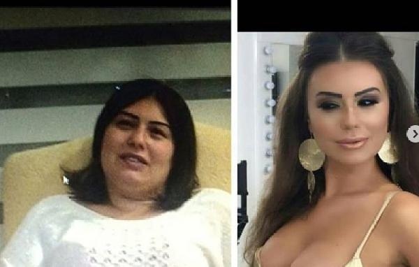 22'nci kez estetik ameliyatı oldu