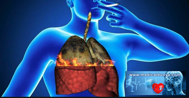10 ÖLÜMCÜL HASTALIKTAN 6’SININ SEBEBİ ‘SİGARA’