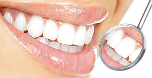 Diş beyazlatmada doğru bilinen yanlışlar!