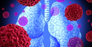 Dikkat... Akciğer kanseri Dünya'da en sık görülen öldürücü kanser türü