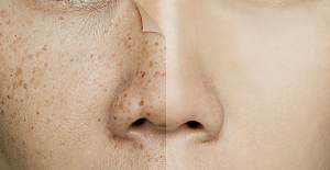 Cilt lekesi neden olur? Çeşitleri nelerdir?